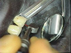 ultrasonic instrument in use